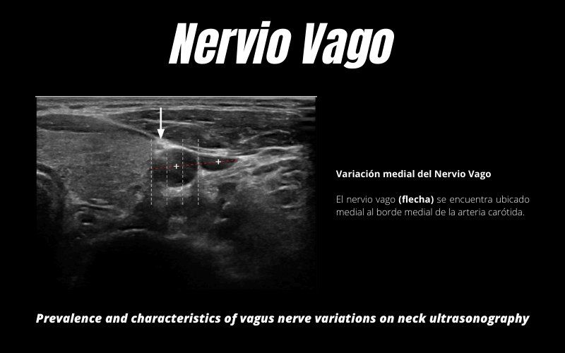 6. Nervio Vago Ecografia Articulo.png